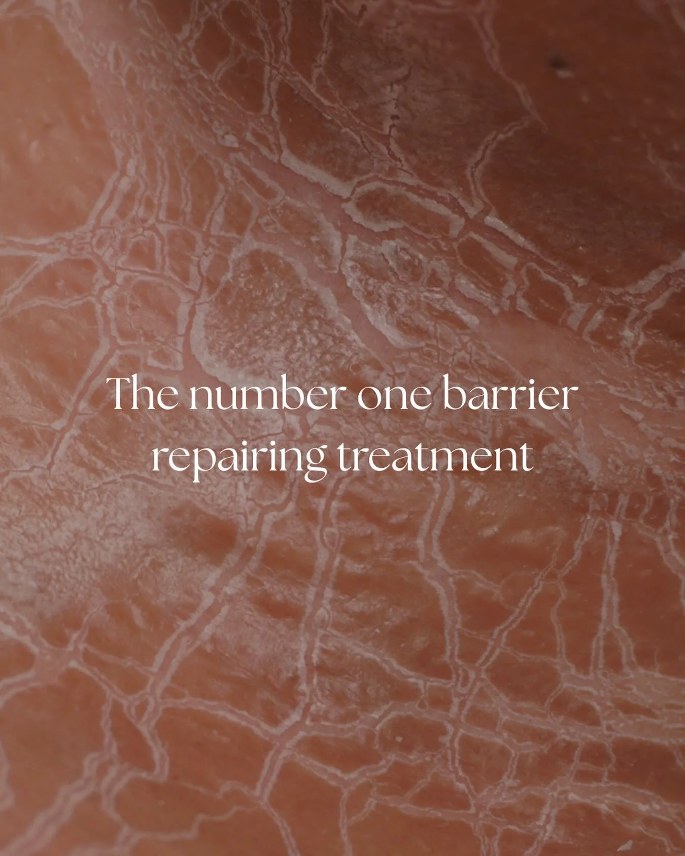 Your skin barrier is the foundation of healthy skin

The DMK Enzyme Peel is our number one barrier repairing treatment. It works with the skin&rsquo;s natural function to strengthen the barrier support circulation and improve overall skin health

By 