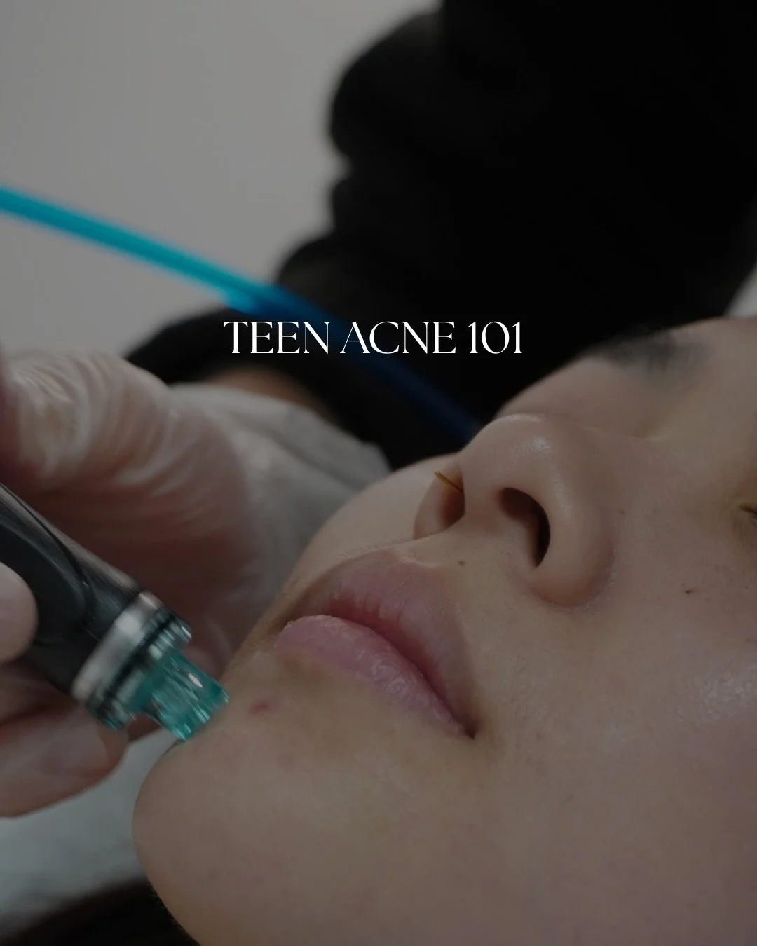 Teen acne can feel overwhelming, but understanding your skin is the first step to clear healthy skin. Hormones, oil, and a developing skin barrier all play a role, and harsh products often do more harm than good. Gentle, consistent care, a focus on i