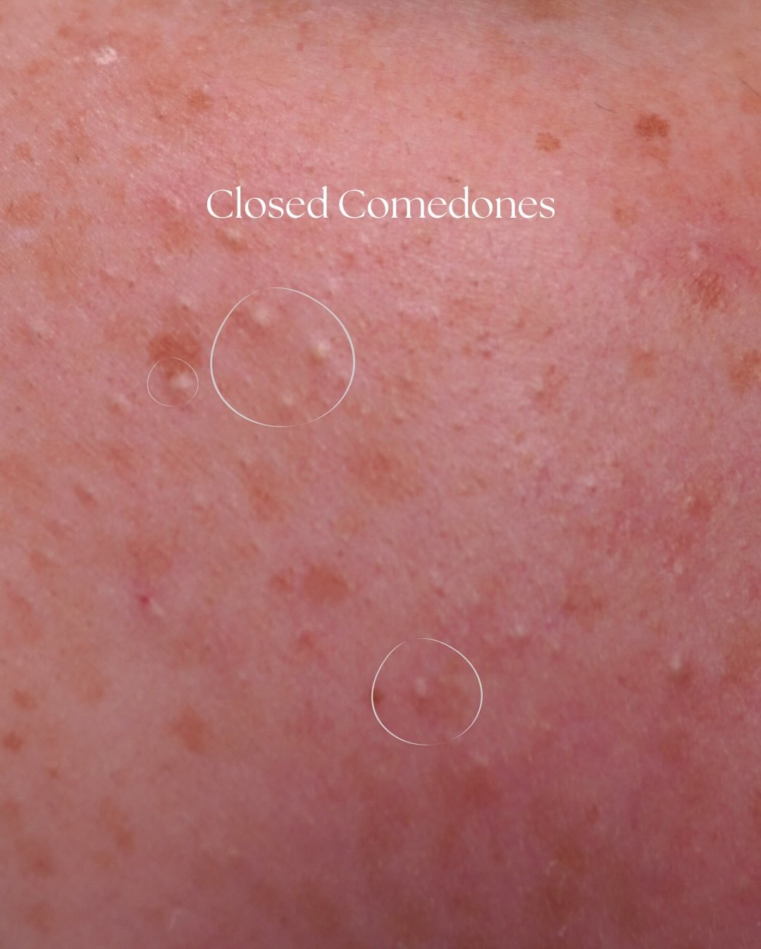 Closed comedones are small flesh coloured bumps that sit beneath the surface of the skin. They occur when pores become clogged with oil dead skin cells and bacteria but remain closed which is why they feel bumpy rather than inflamed

They are commonl