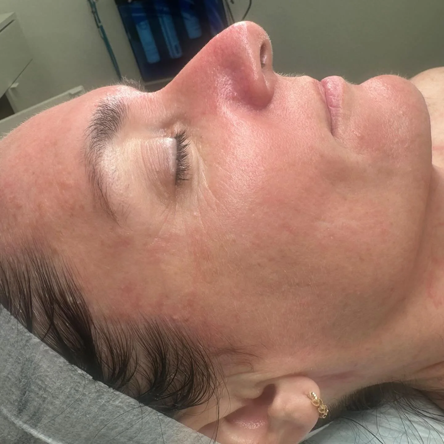 This is the result of consistency ✨
My client here is a regular &mdash; committed to targeting dullness and fine lines.
By combining our Skin Needling with the powerful DMK Enzyme Treatment, we&rsquo;re working smarter, not harder&hellip; boosting co
