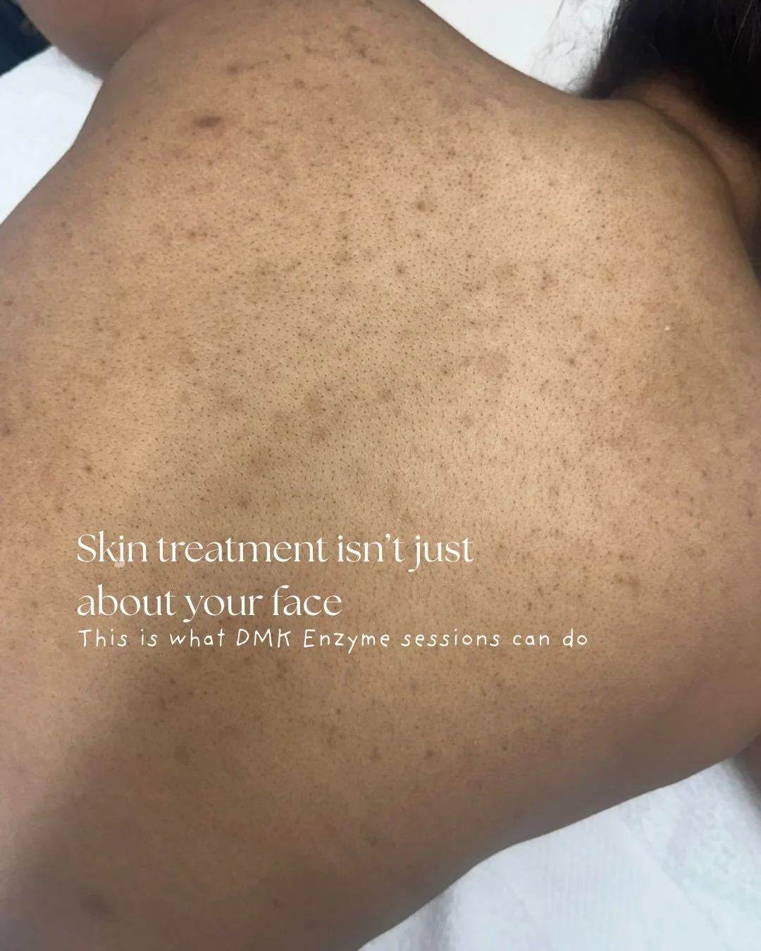 ✨ Skin treatment isn&rsquo;t just about your face! Our client&rsquo;s back has never looked smoother after 3 sessions of DMK Enzyme Therapy. Pigmentation and congestion are visibly reduced, leaving her skin clear, even, and refreshed. 💆&zwj;♀️

#Bac