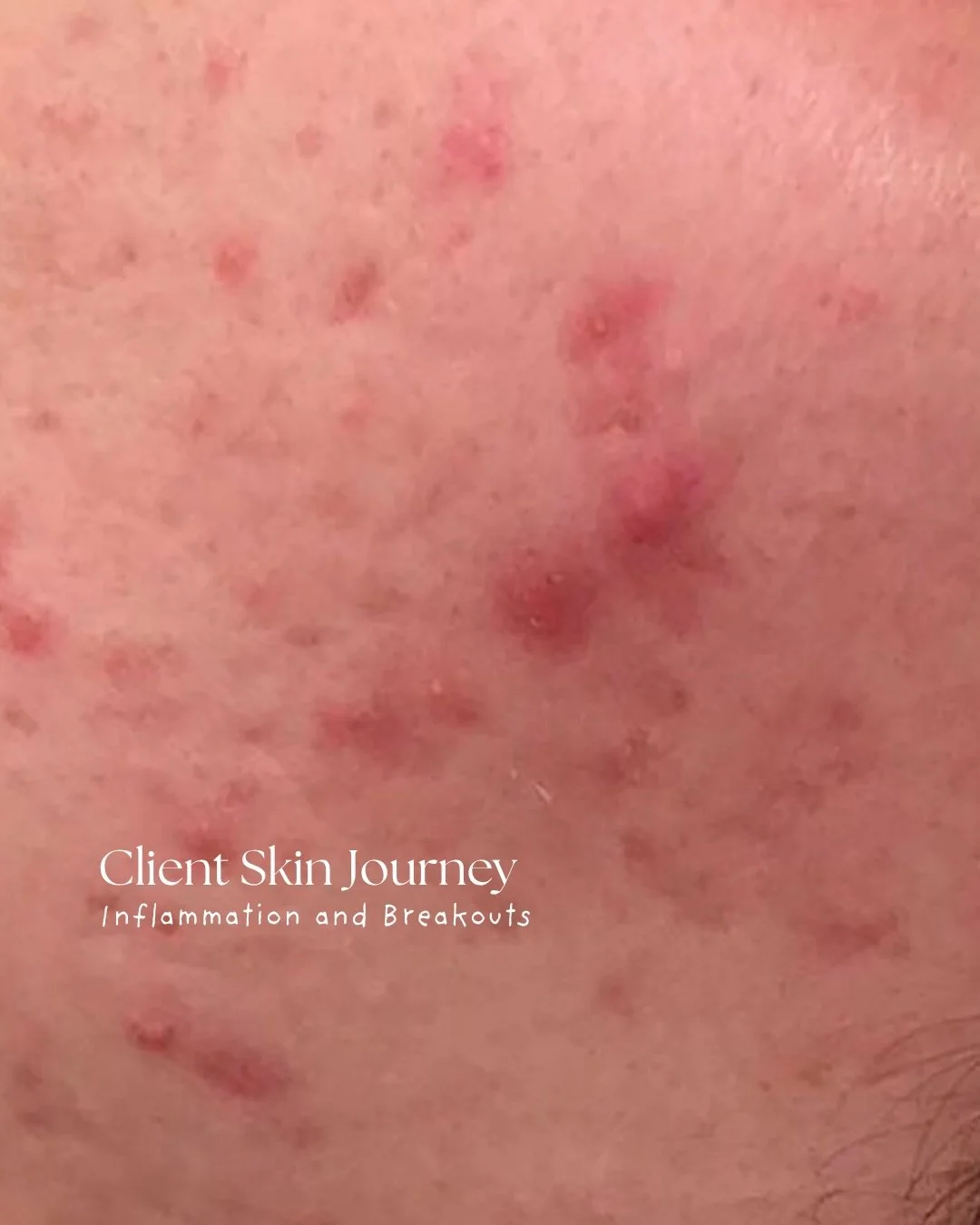 This is your reminder that real skin takes time, intention, and the right treatments 🤍

Our client came to us experiencing severe acne breakouts, inflammation, and persistent redness. Her skin barrier was compromised, reactive, and in need of true c