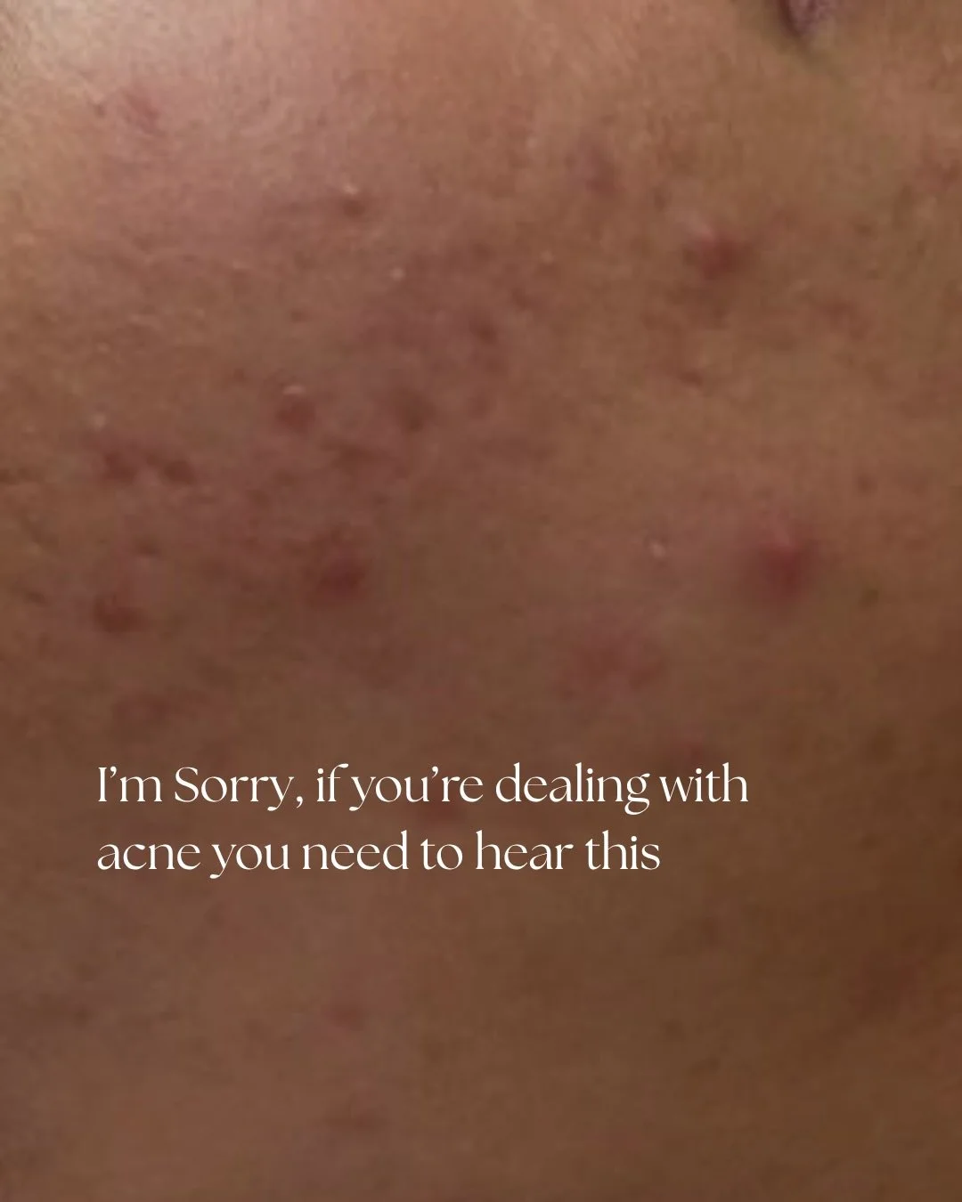 Acne doesn&rsquo;t just affect your skin&hellip; it affects how you feel every single day.

This is your reminder that progress is possible when you stay consistent with the right treatments, home care, and lifestyle support.

No quick fixes, just re