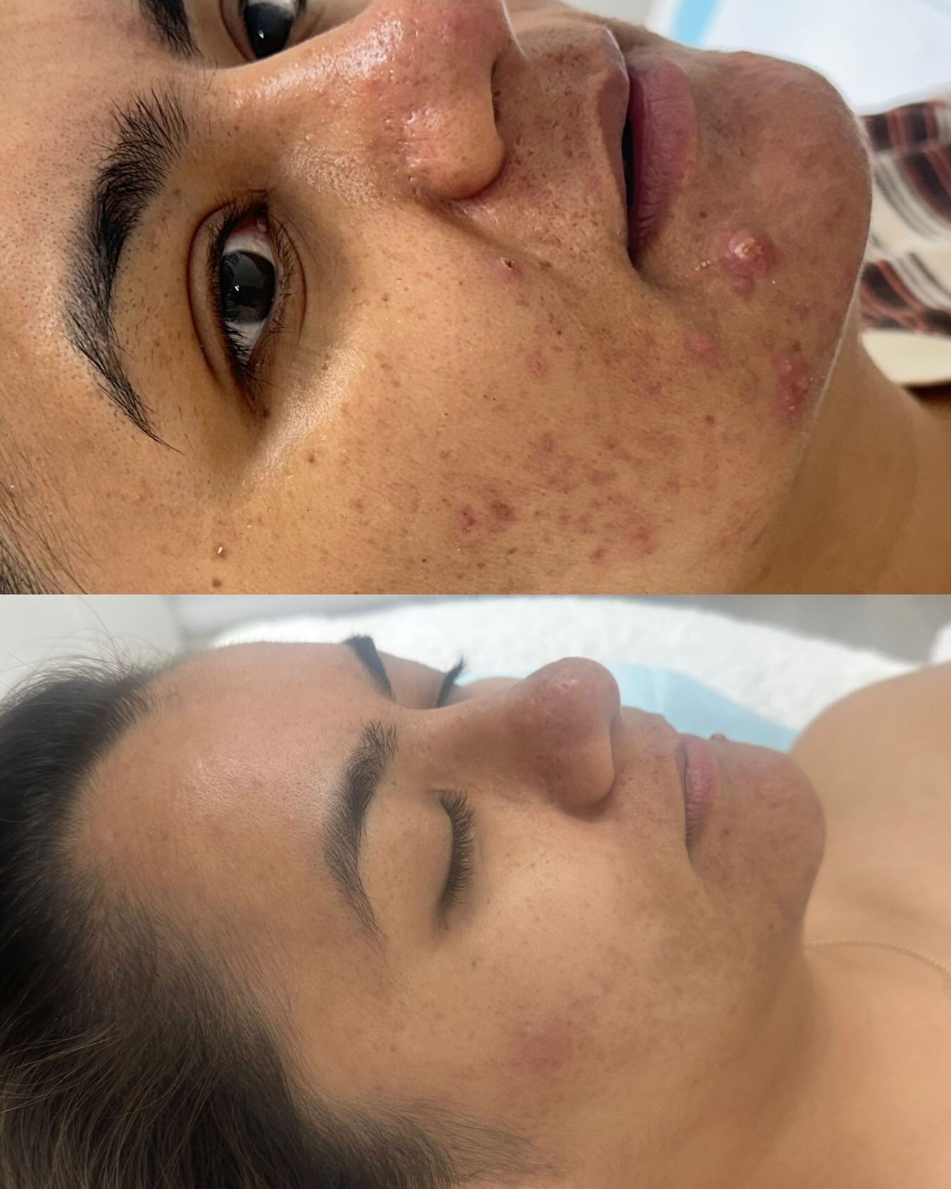 This is what happens when you stop guessing&hellip; and start treating your skin properly.

Top: inflamed breakouts, congestion, and compromised skin barrier
Bottom: calmer, clearer skin with reduced inflammation and improved texture

Acne isn&rsquo;