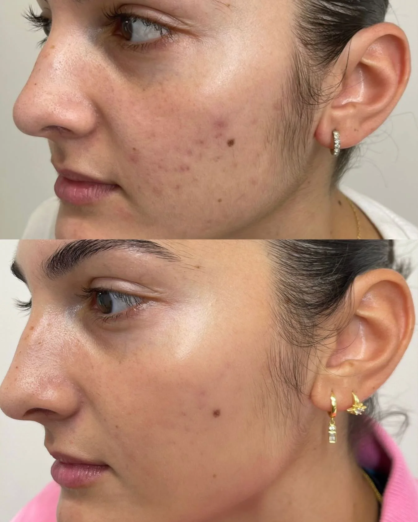 Real skin. Real results.

Targeting congestion, calming inflammation, reducing acne scarring, and refining overall texture &mdash; this is what consistent, corrective skin treatments look like when they&rsquo;re done right. No filters, no shortcuts, 