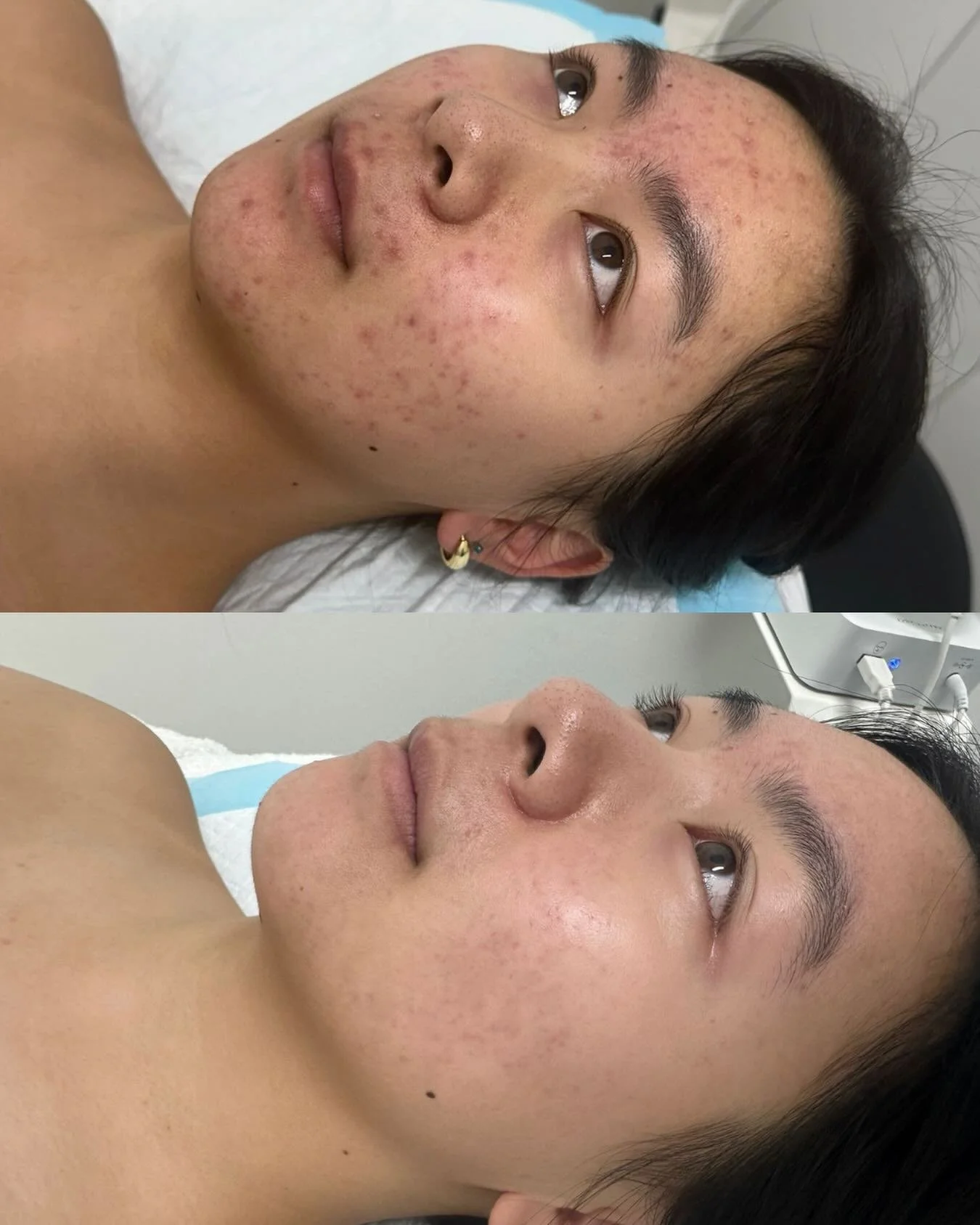 Real skin. Real progress. ✨

This transformation didn&rsquo;t happen overnight &mdash; but with consistency, the right treatment plan, and skin-focused care, the difference speaks for itself.

We focused on calming inflammation, improving texture, an