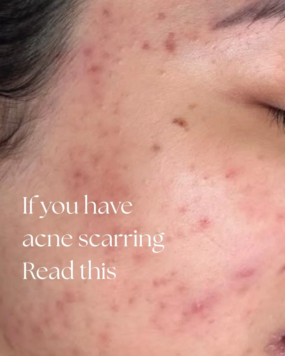Can you get rid of acne scarring?

It comes down to understanding the cause, choosing the right treatment, and staying consistent.

Acne scarring forms when inflammation damages the skin and disrupts collagen during the healing process.

The good new