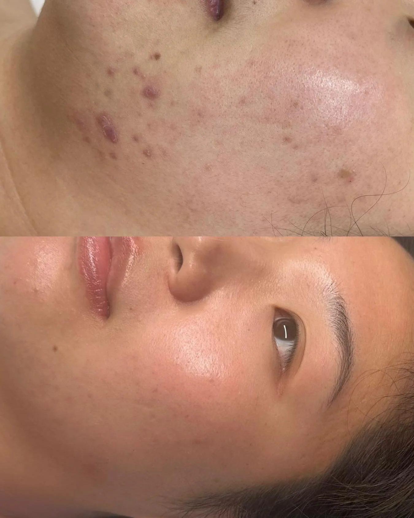 We love nothing more than watching a client&rsquo;s confidence grow alongside their skin 🤍 

This beautiful result came from commitment - monthly Hydrafacials targeting chin acne over time. Clear skin is possible. Book your skin consultation via the
