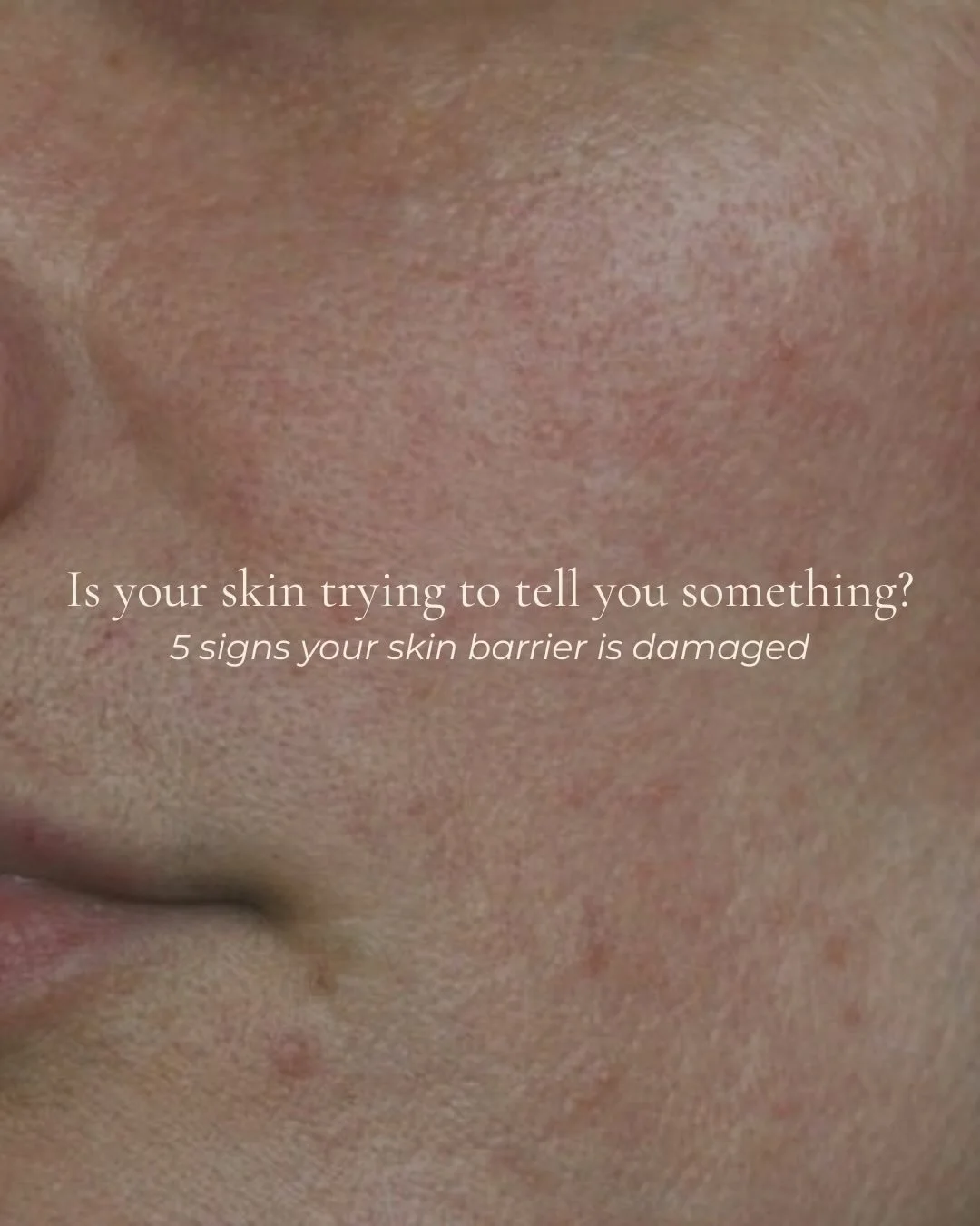 Your skin barrier is your first line of defence &mdash; and when it&rsquo;s compromised, nothing in your routine will work the way it should.
Acne. Sensitivity. Dehydration. Redness. 

Most people treat these as separate
problems. But often, they&rsq