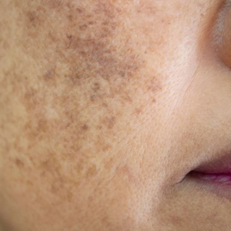 Hyperpigmentation &amp; Sun Damage