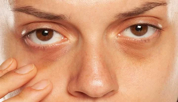 Periorbital Ageing &amp; Dark Circles