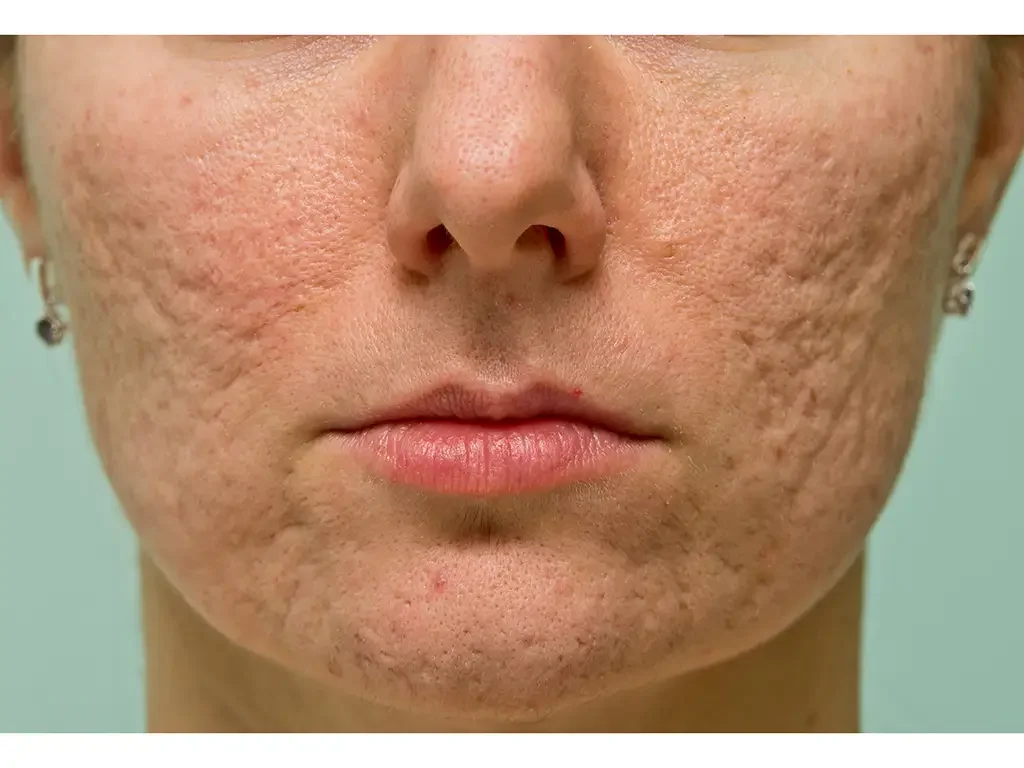 Acne Scarring &amp; Texture Issues