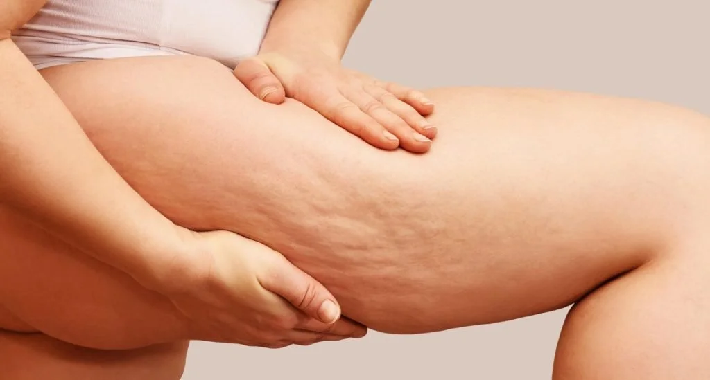 Cellulite