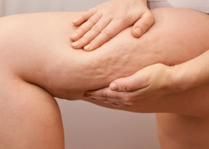 Fluid Retention &amp; Cellulite