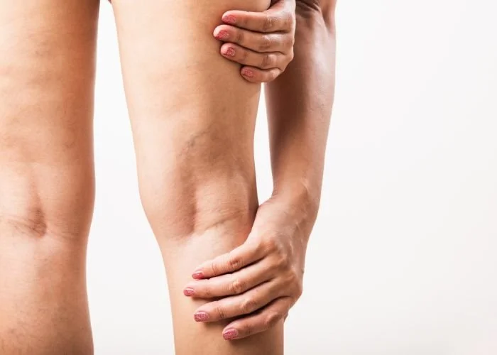 Leg Veins &amp; Vascular Lesions