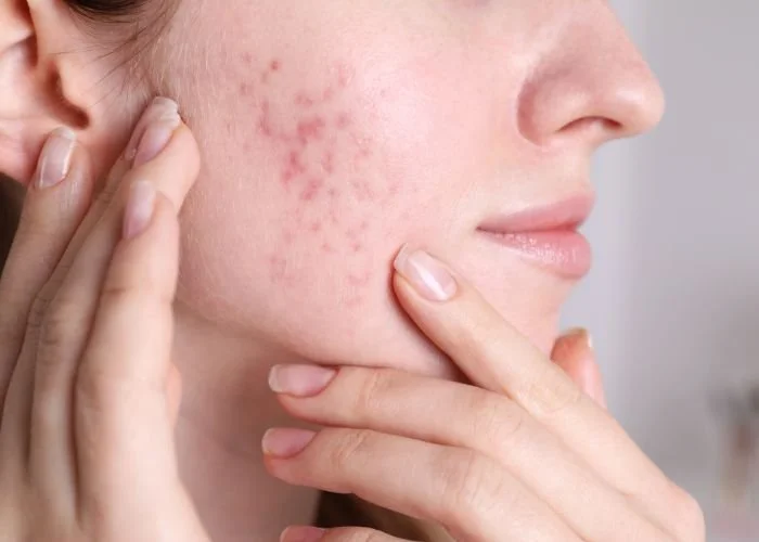 Active Acne &amp; Congestion