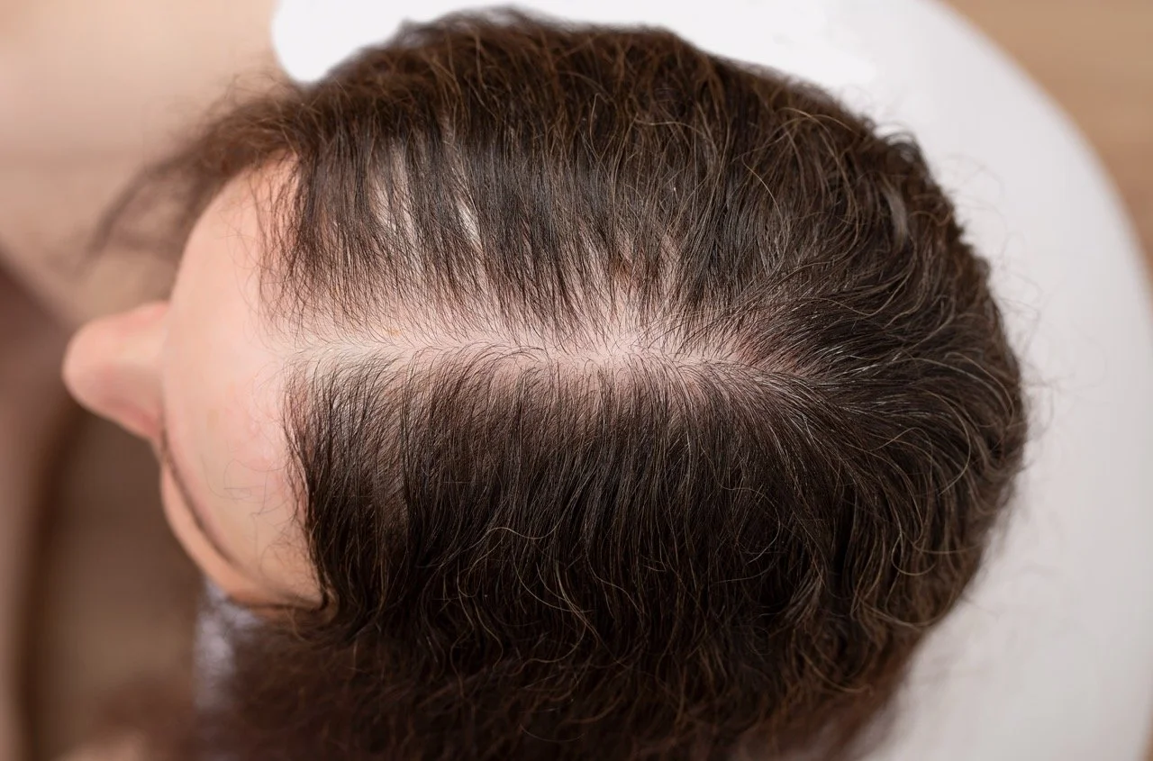AdobeStock_531230221 - hair loss woman parting Large.jpeg