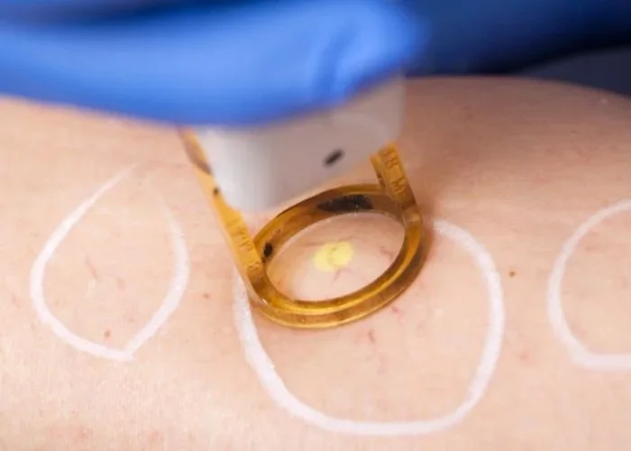 Vein Removal