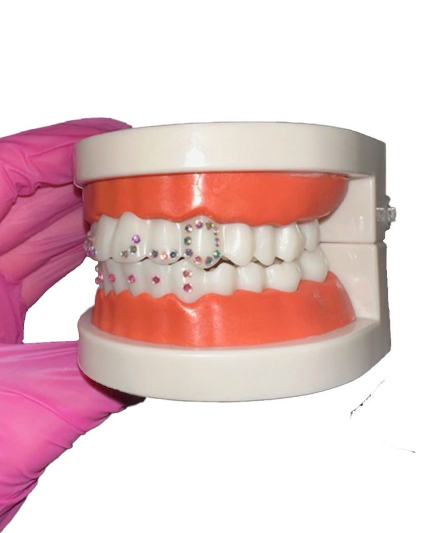 Dental model showing a set of teeth with braces and decorative rhinestones, held by a hand in a pink glove.