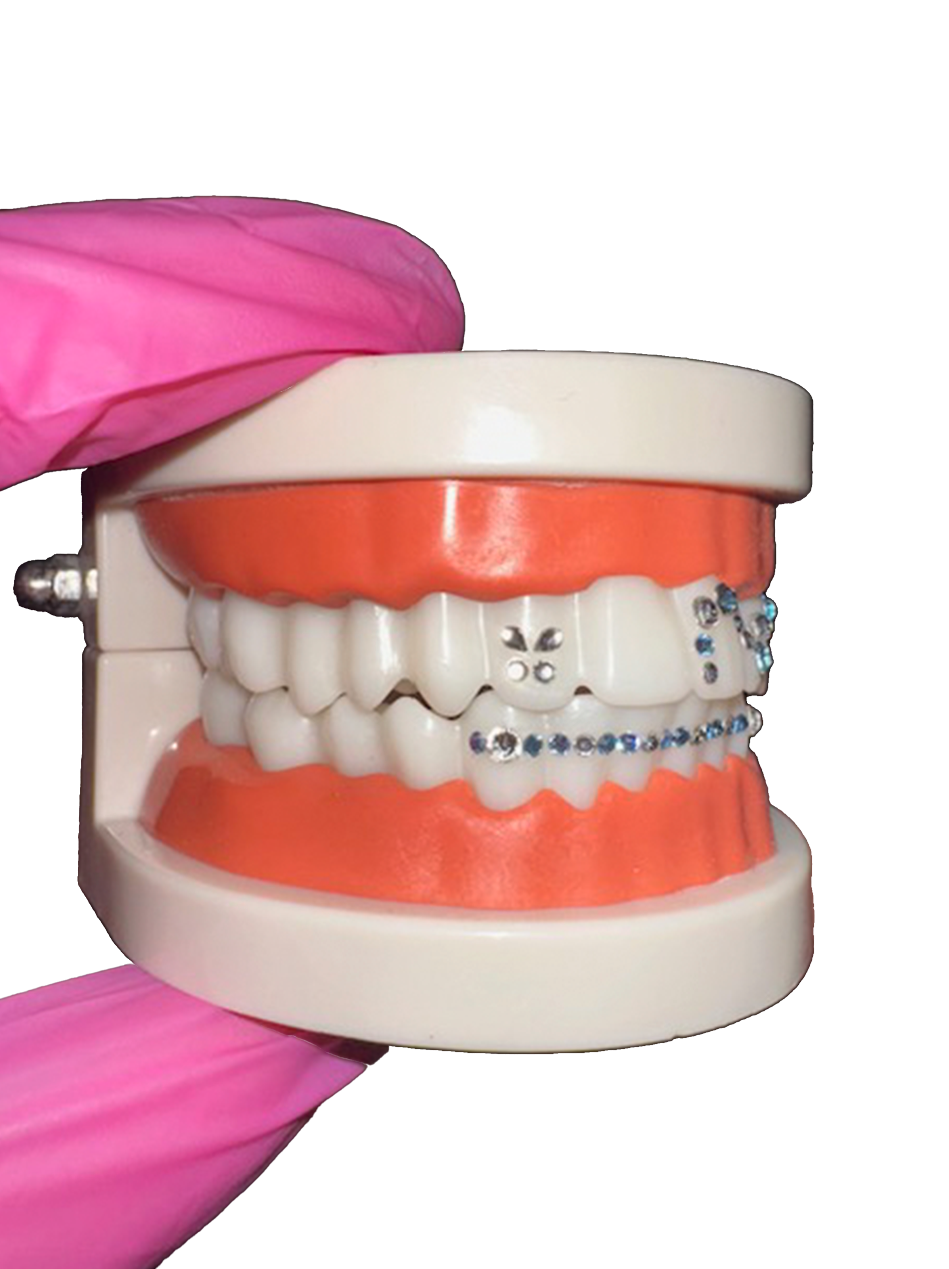 Dental model with orthodontic braces on upper and lower teeth, held by a gloved hand.