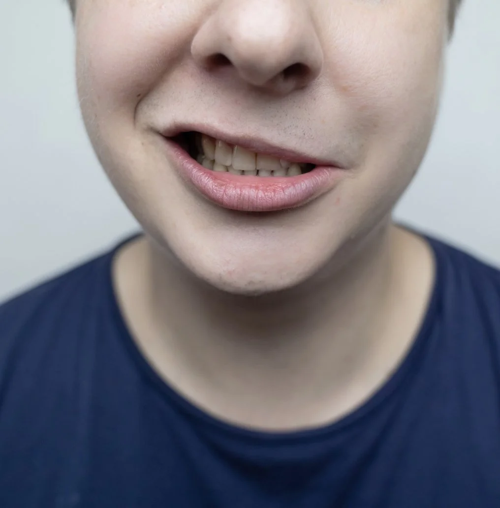 Facial palsy: How to support your recovery in the early flaccid stages