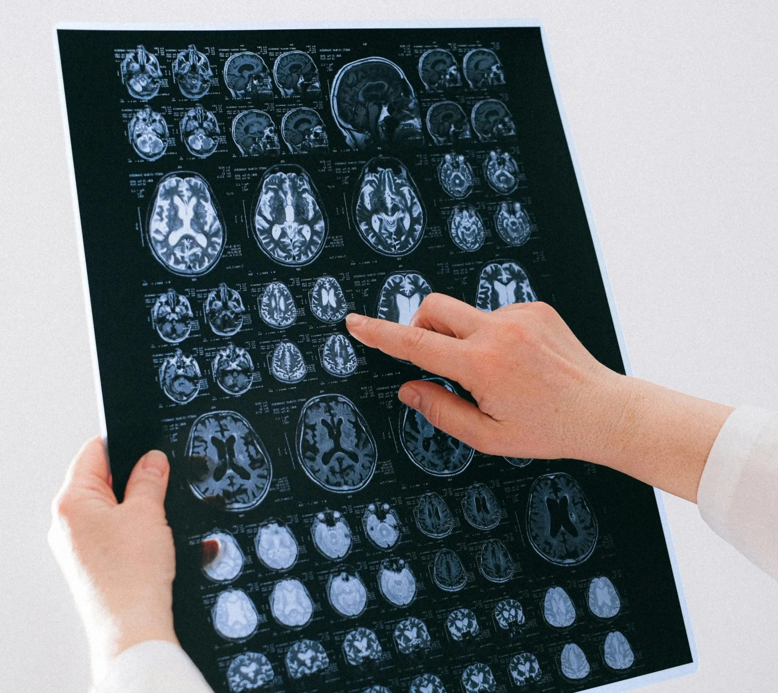 The Man who Mistook his Patient for a Brain: A critical analysis of Oliver Sacks’ treatment of character in his writing