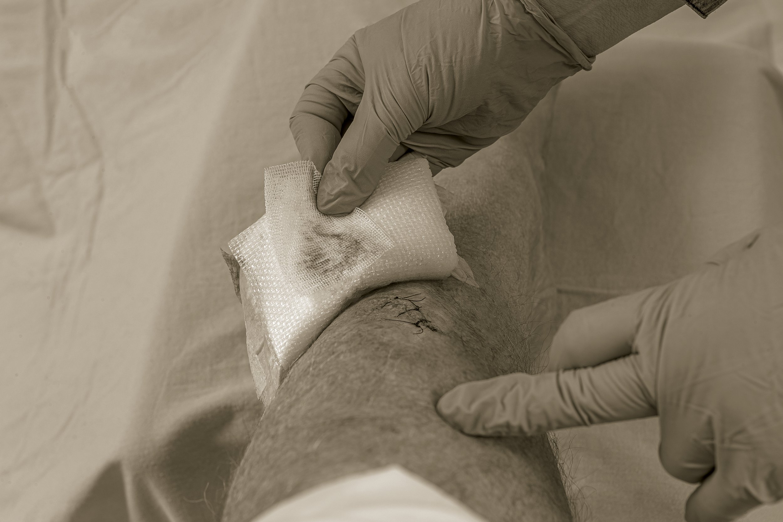 A healthcare professional wearing gloves is applying a bandage or dressing to a person's leg, which has a surgical or wound incision.