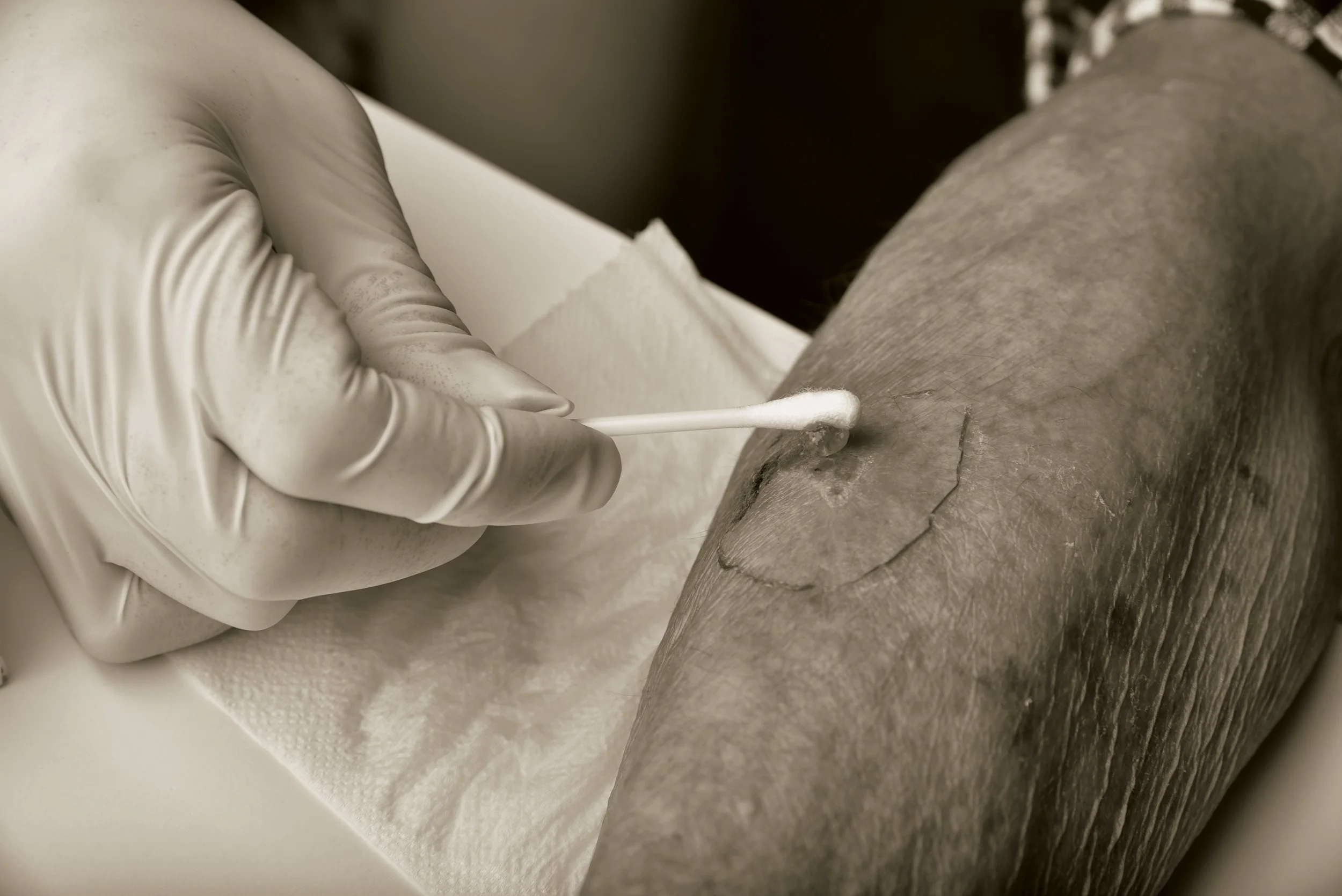 A person wearing gloves applies a treatment or dressing to a large, open wound on their lower leg.