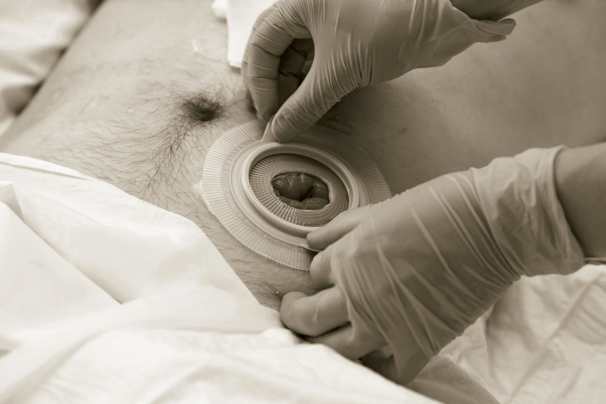 A medical professional wearing gloves inserts a device with a tube into a patient's abdomen near the navel, likely for medical drainage or access.