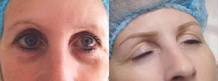Deanne Perkins Advanced Eyebrow Correction.