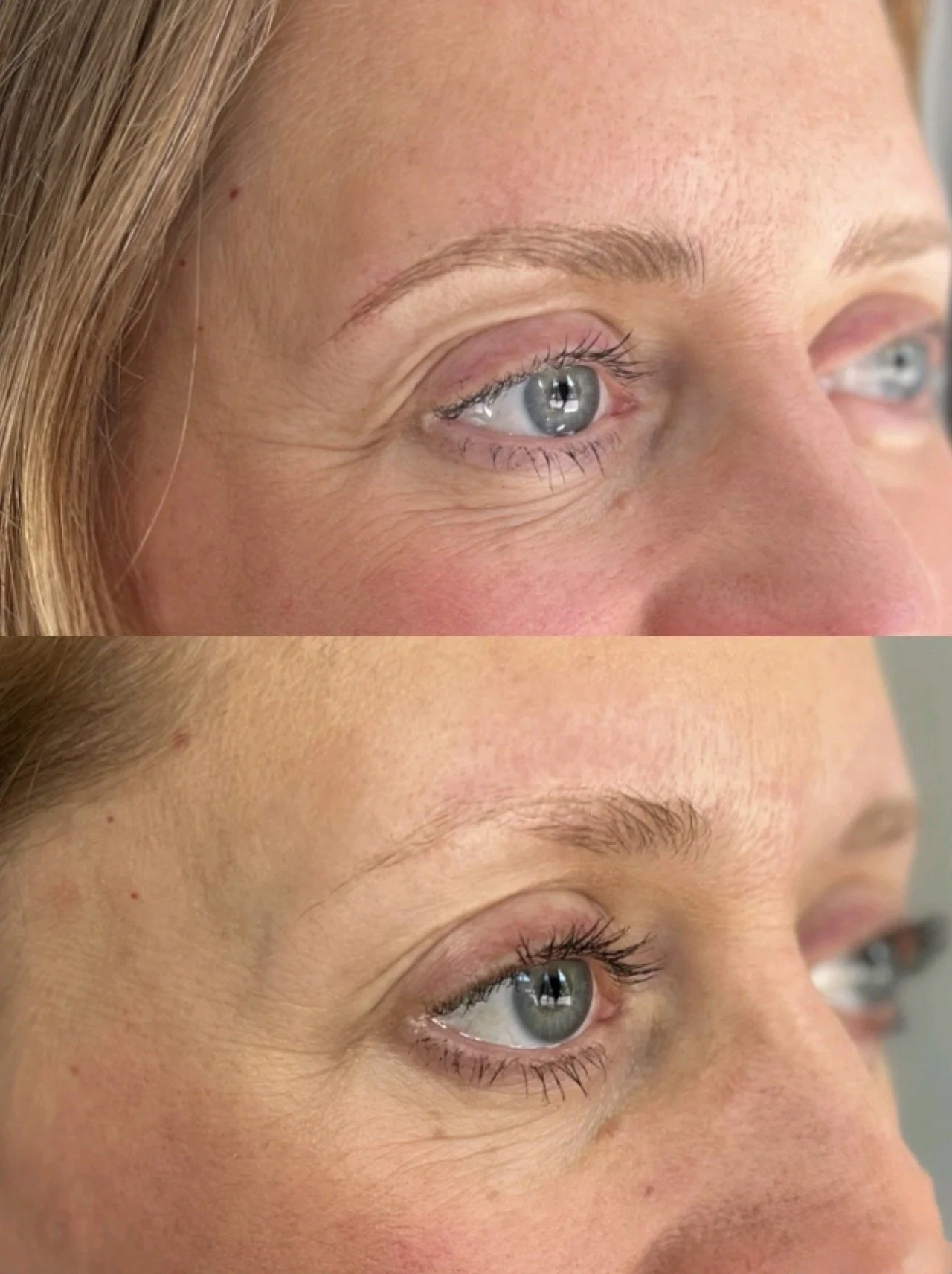 Close-up of a woman's face showing before and after cosmetic eyelid treatment, with visible reduction in eyelid skin and wrinkles.