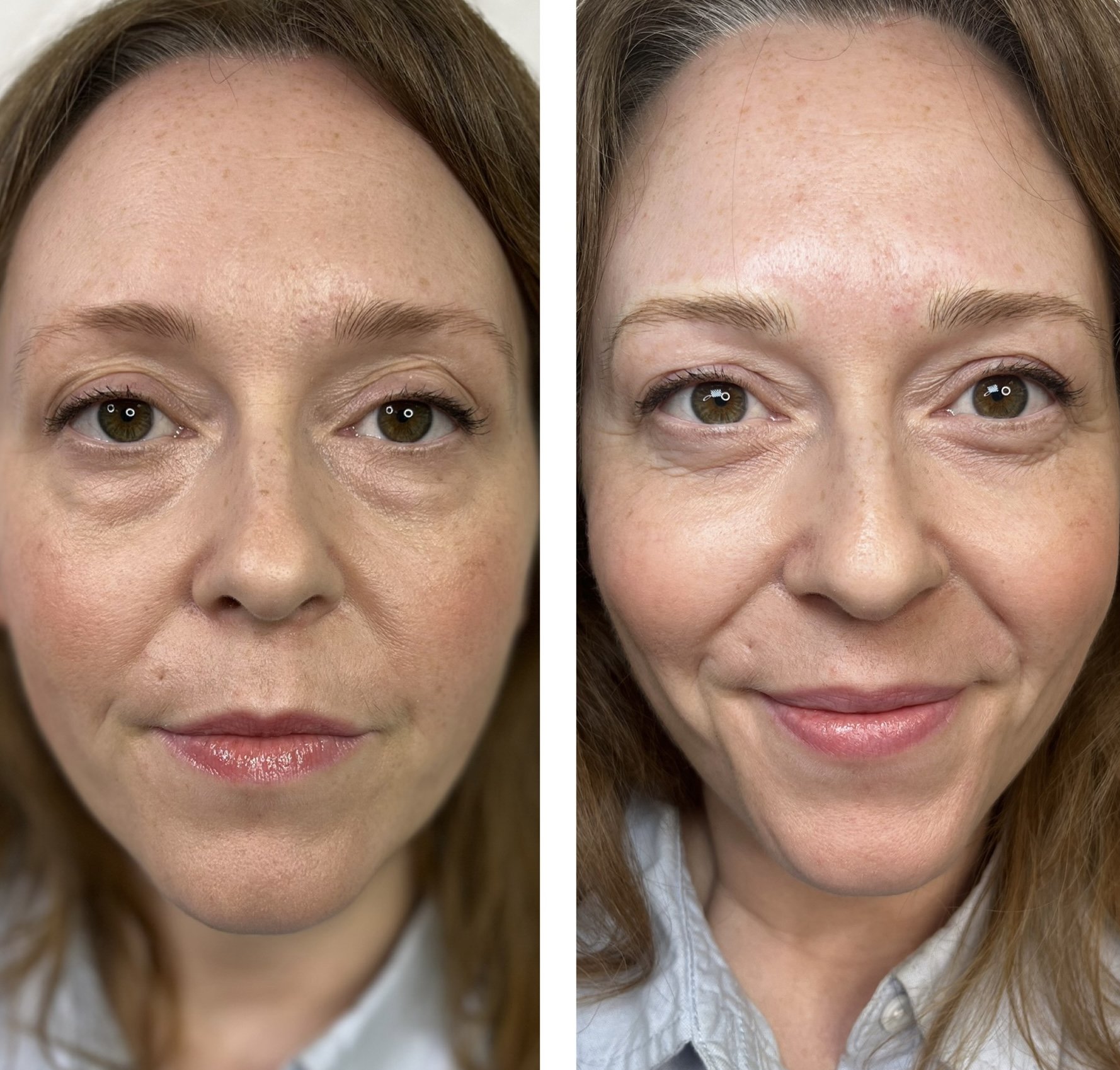 Side-by-side comparison of a woman before and after skincare treatment, showing improvement in skin texture and appearance.