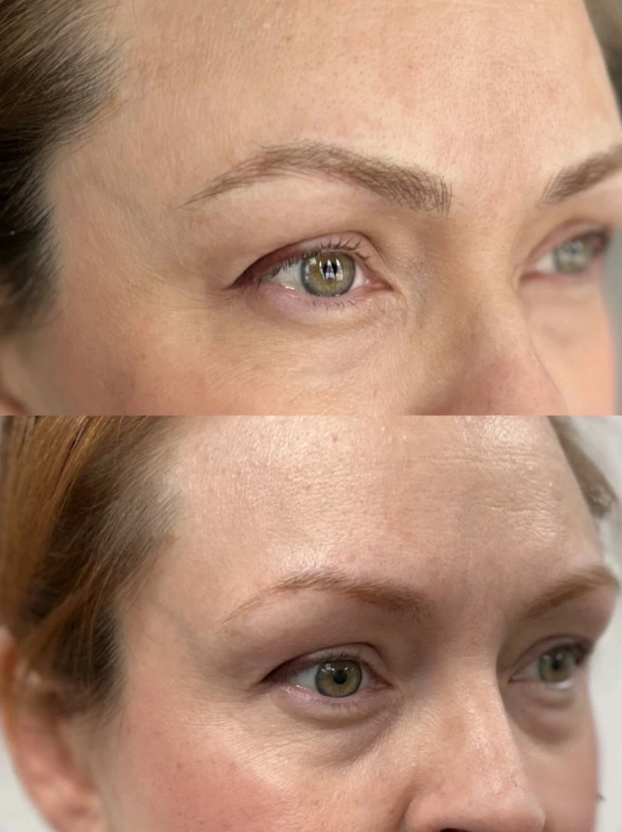 Close-up comparison of a woman's face showcasing the before and after results of eyelid cosmetic surgery, highlighting the eyelids and surrounding skin.