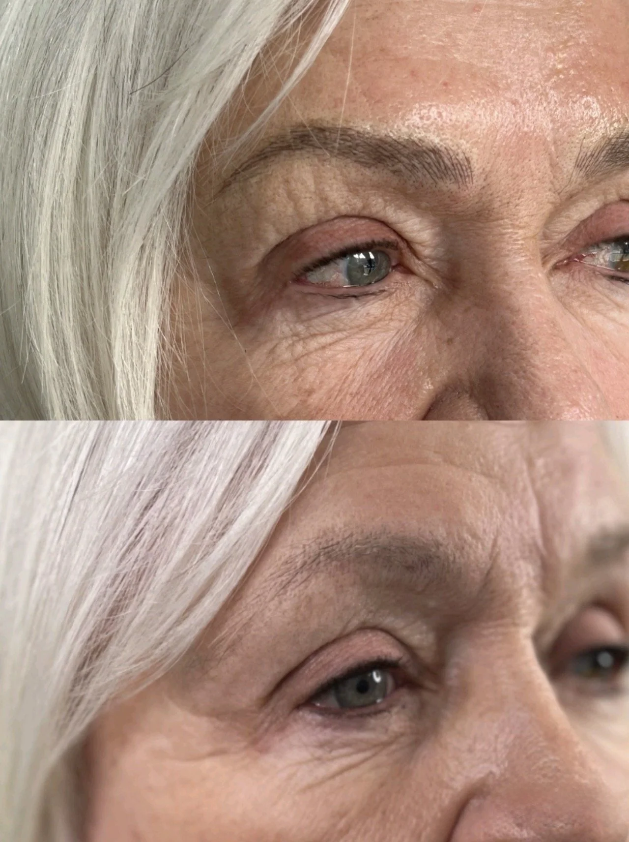 Close-up comparison of a woman's eye and surrounding skin before and after cosmetic treatment, showing reduced wrinkles and improved skin appearance.