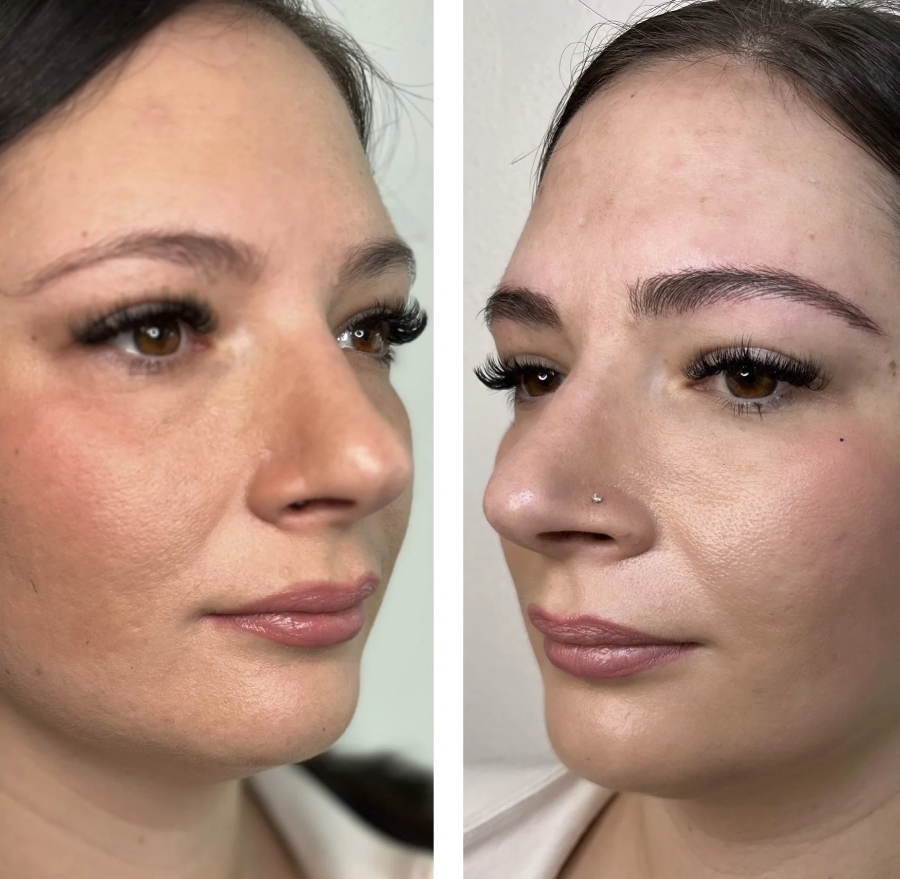 Close-up of a woman's face before and after cosmetic procedure, showing changes in skin texture and facial features.