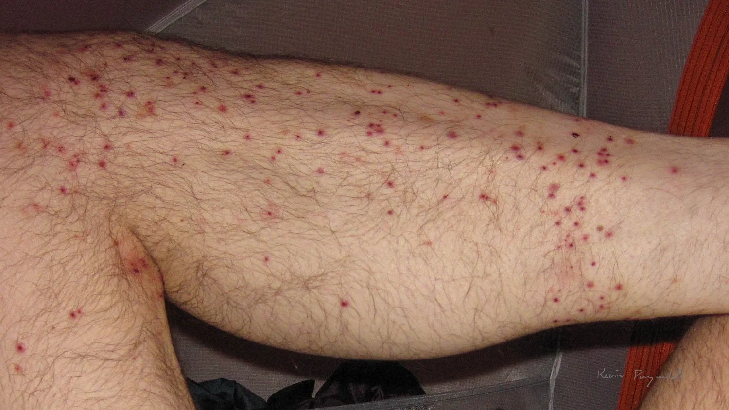 Blackfly bites after not fully tucking my pants into my socks