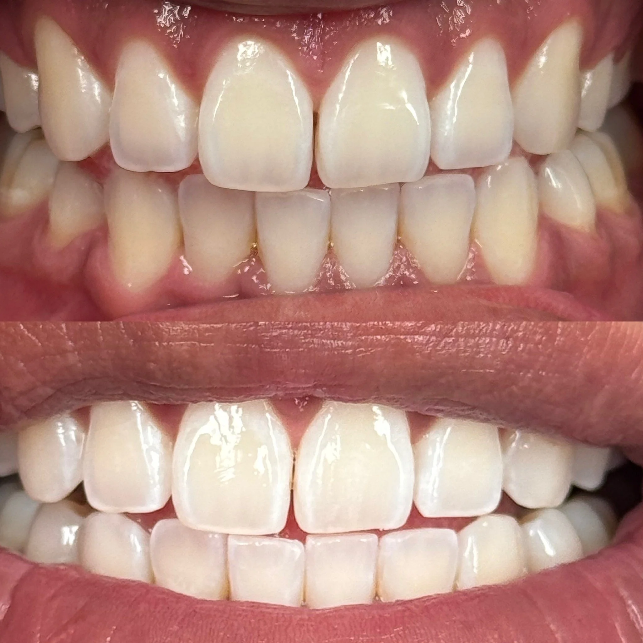 Comparison of teeth before and after dental whitening treatment, with visibly whiter teeth in the bottom image.
