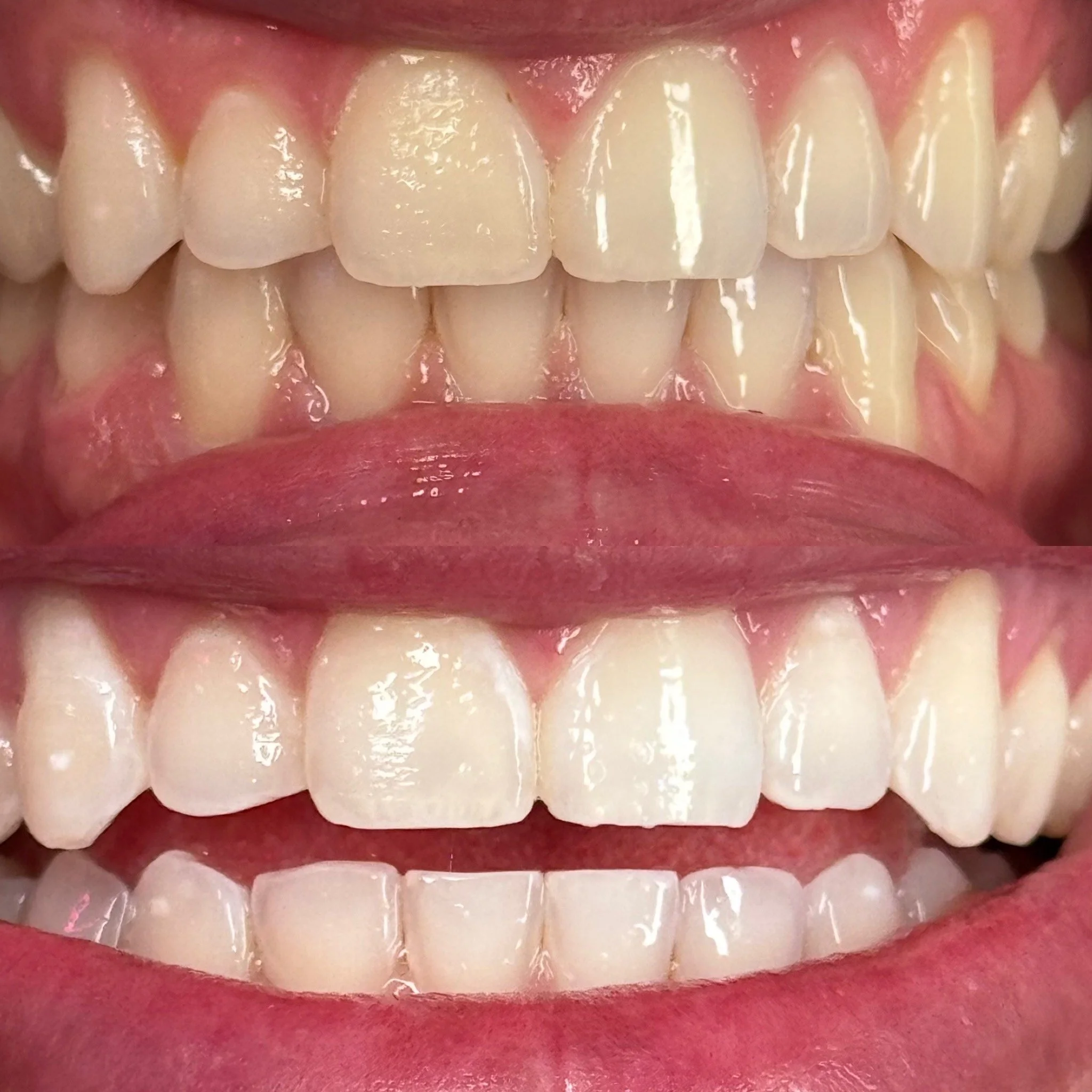 Close-up of a person's teeth showing before and after dental cleaning or whitening, with the top row appearing more stained or yellow compared to the cleaner, whiter teeth in the bottom row.