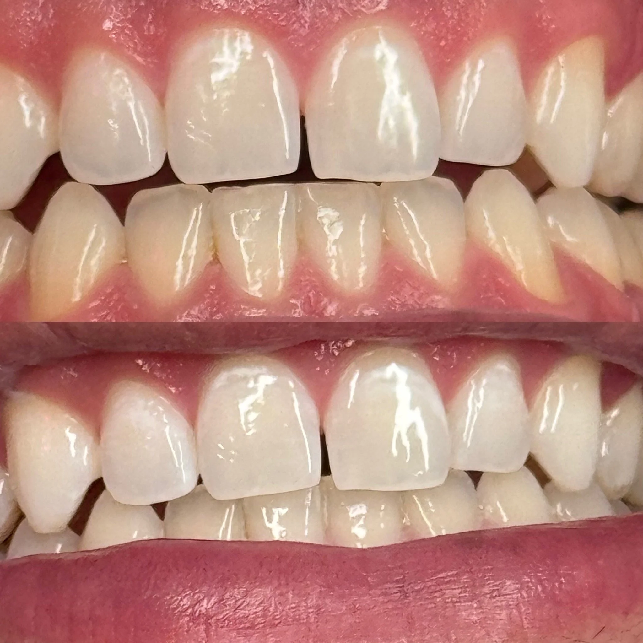 downey-teeth-whitening-glimmer-grinz