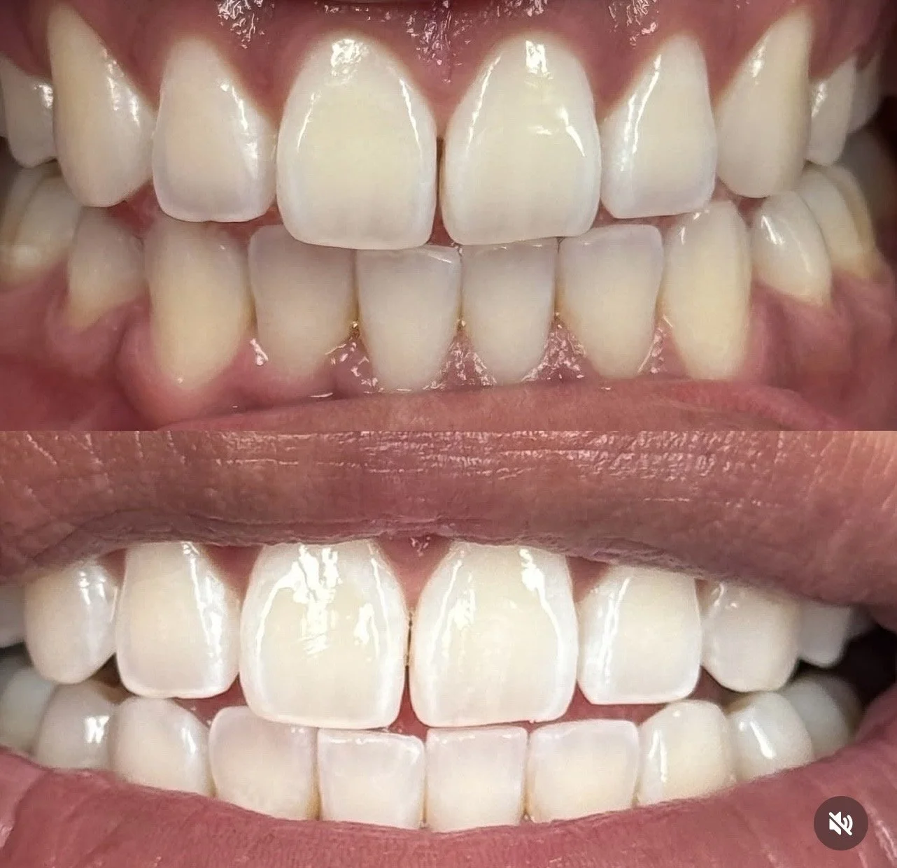 downey-teeth-whitening-glimmer-grinz