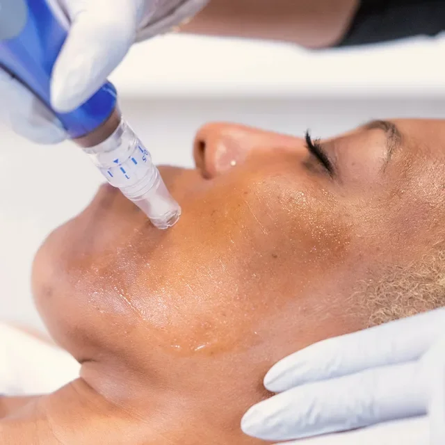 Microneedling with Ariessence™ PDGF