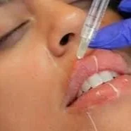 Dermal Filler