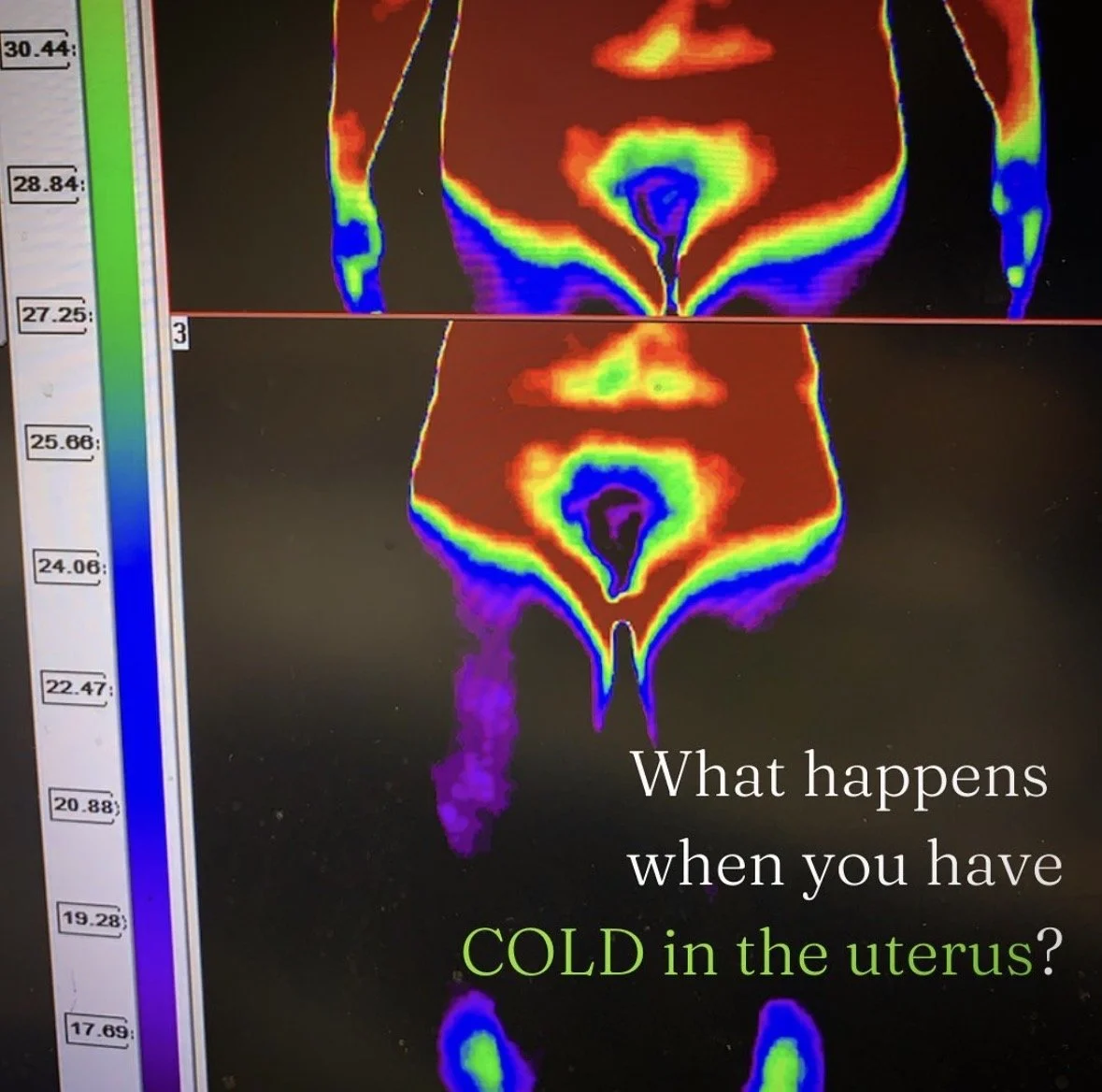 Colorful thermal images of a female pelvic area showing temperature differences, with a caption reading 'What happens when you have COLD in the uterus?' and a temperature scale on the left.