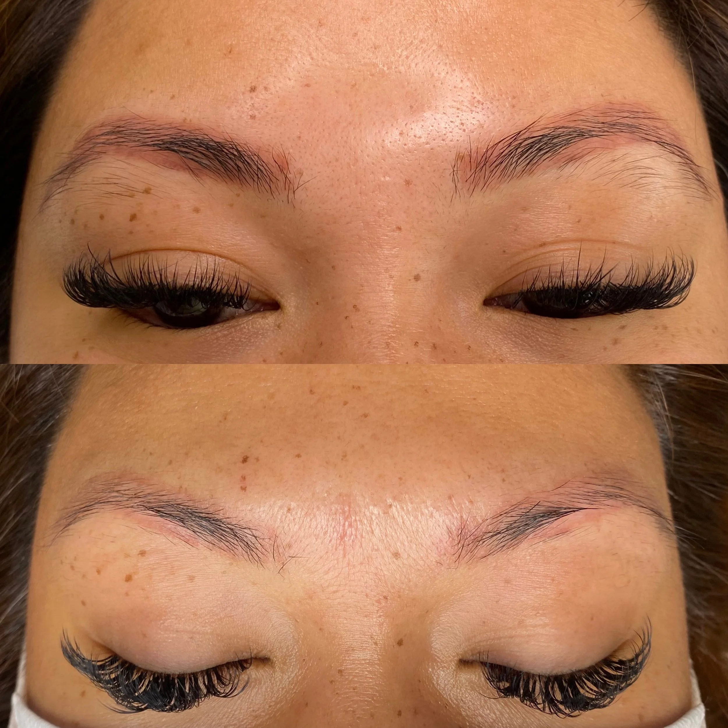 Saline Tattoo Removal
