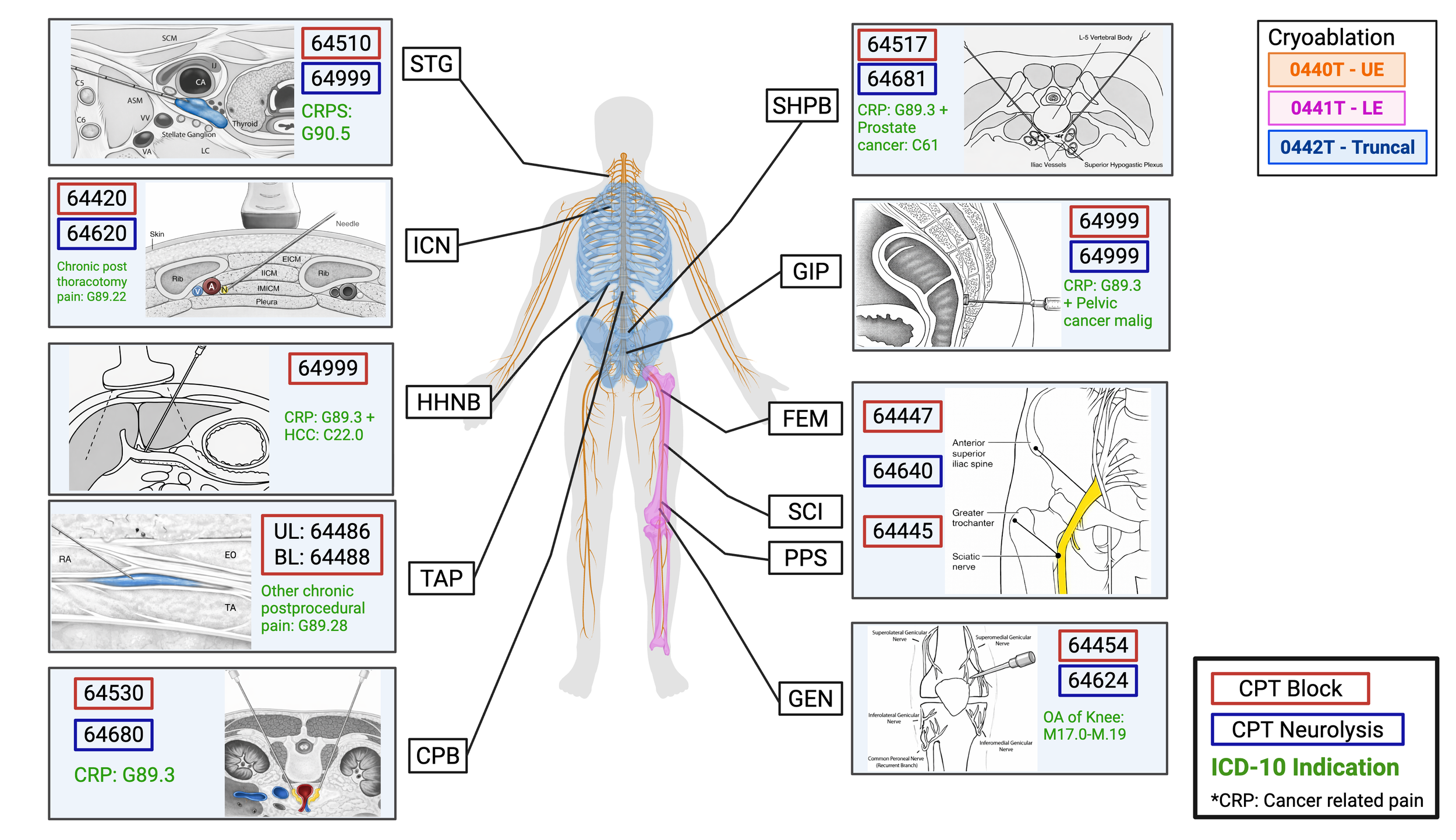 Nerve Block Cards — Over the wire