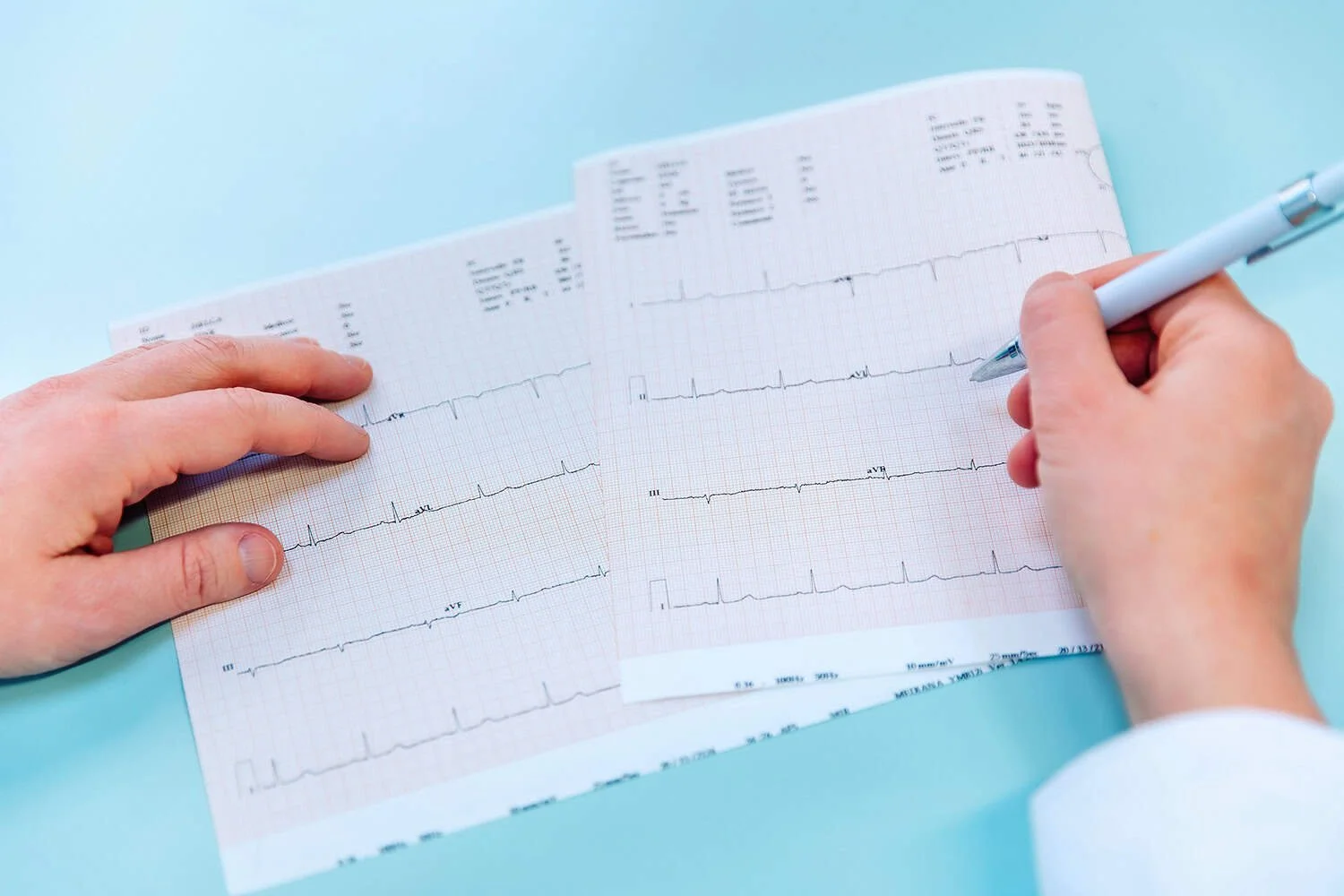 Eine Hand hält einen Kardiogramm-Anteil auf Papier, während die andere Hand mit einem blauen Stift Notizen macht.