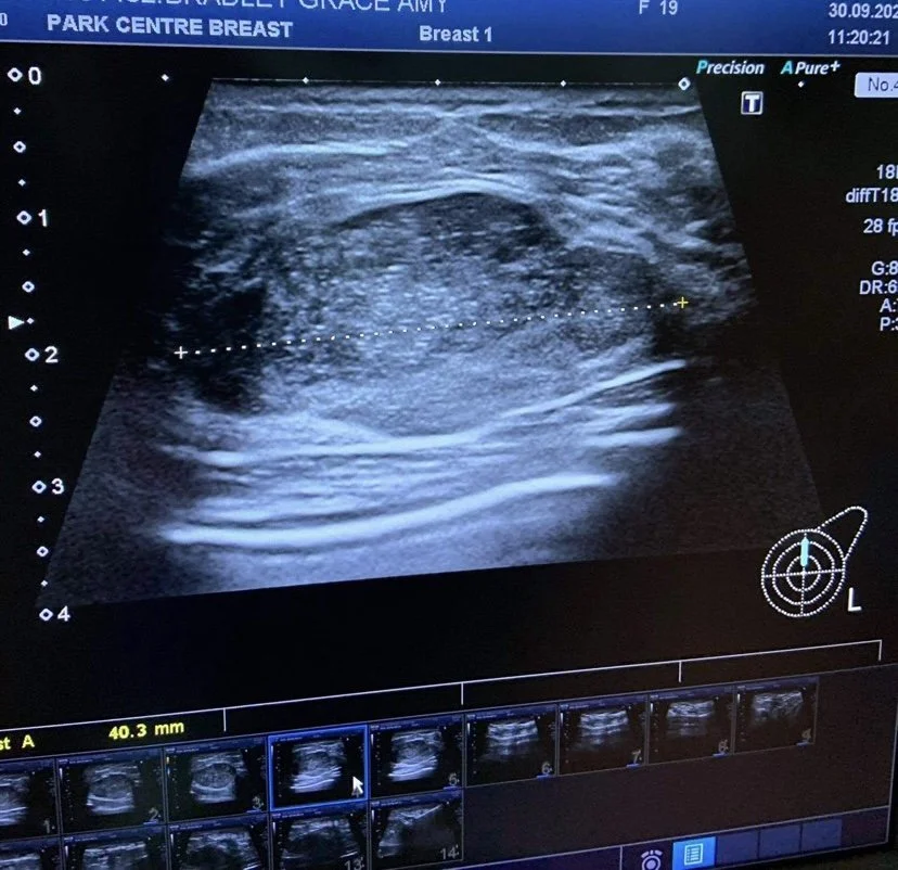 Ultrasound image of breast tissue during a medical exam, with measurement markers