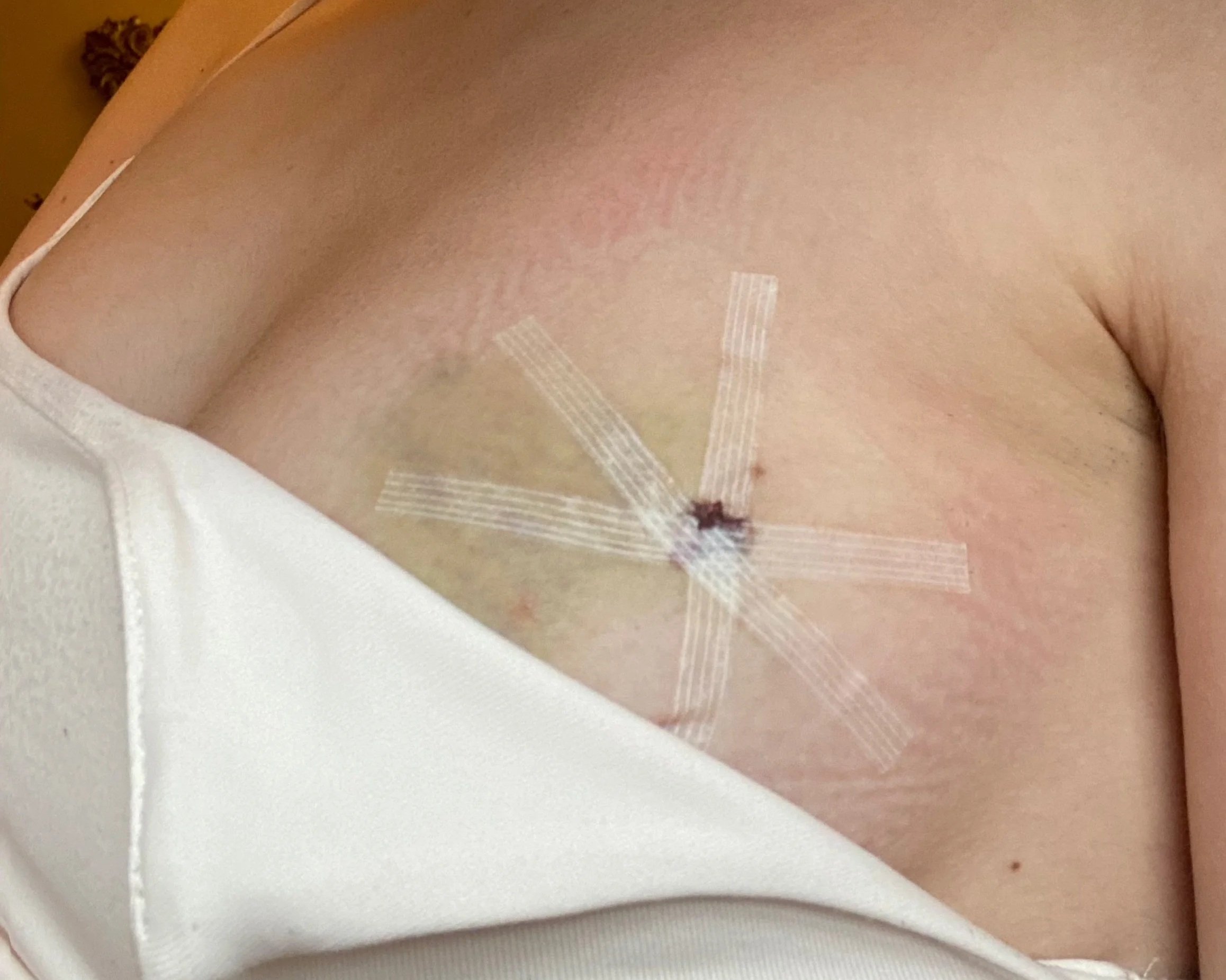 Close-up of a person's chest with clear medical adhesive strips holding a small wound closed.