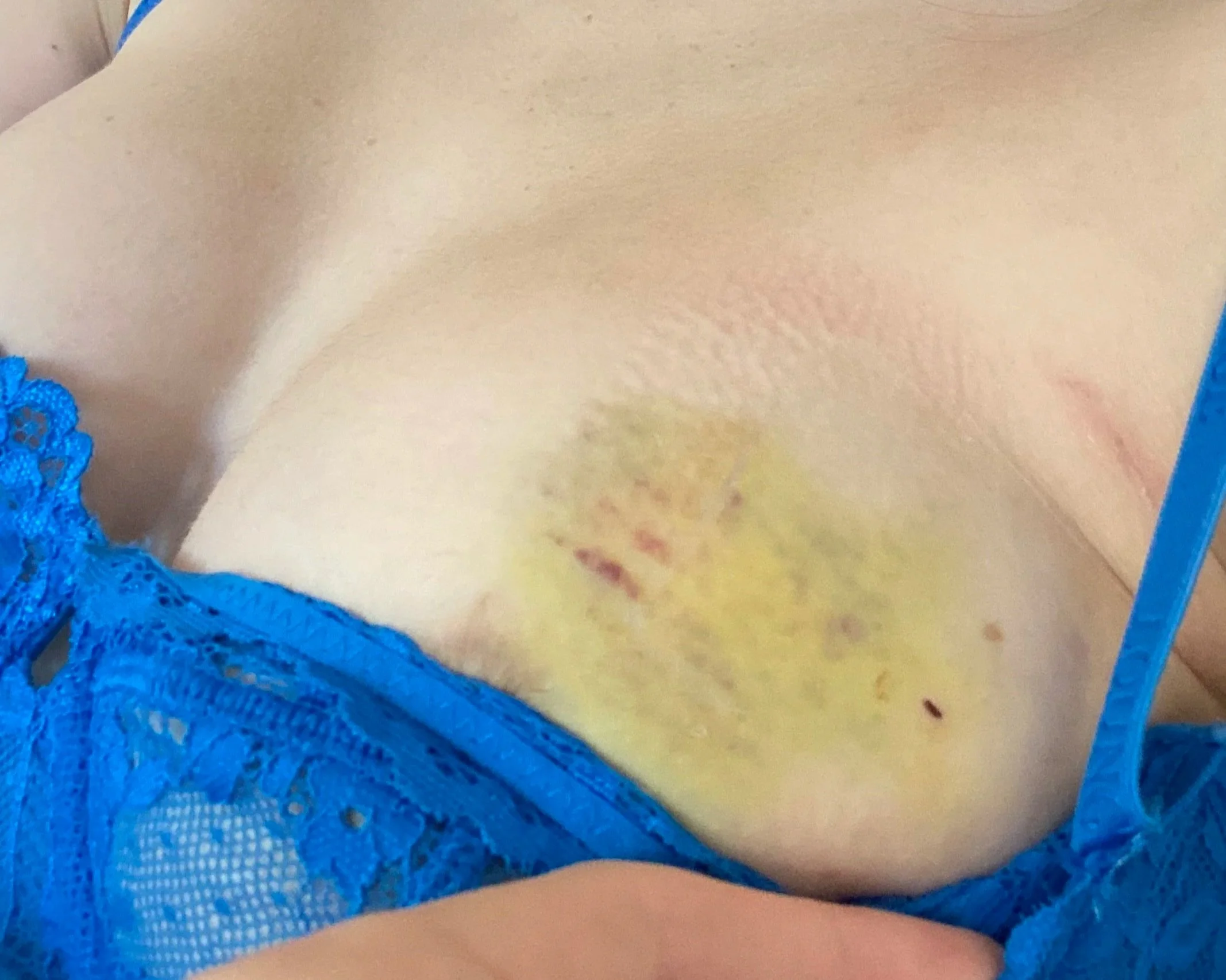 Close-up of a person's neck and shoulder with a blue lace fabric partly covering the skin.