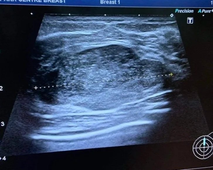 Ultrasound image of breast tissue, showing internal structures with varying shades of gray and scattered bright spots.